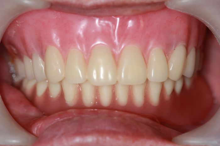 植牙輔助活動假牙