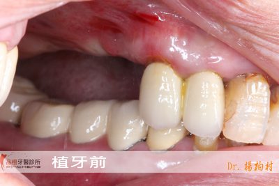 上顎竇補骨 +植牙(案例1)