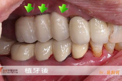 上顎竇補骨+植牙(案例3)