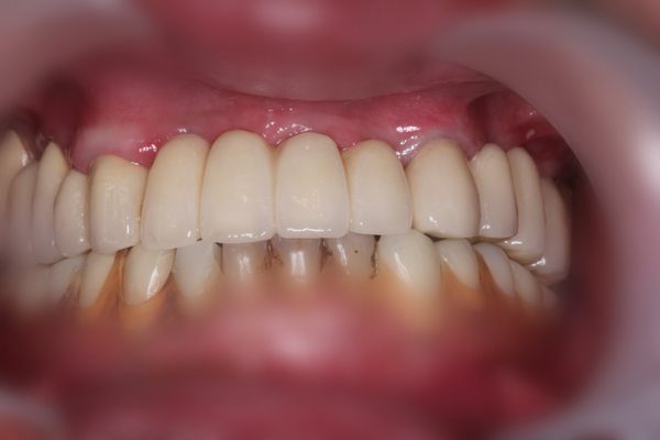 美觀區植牙(案例1)