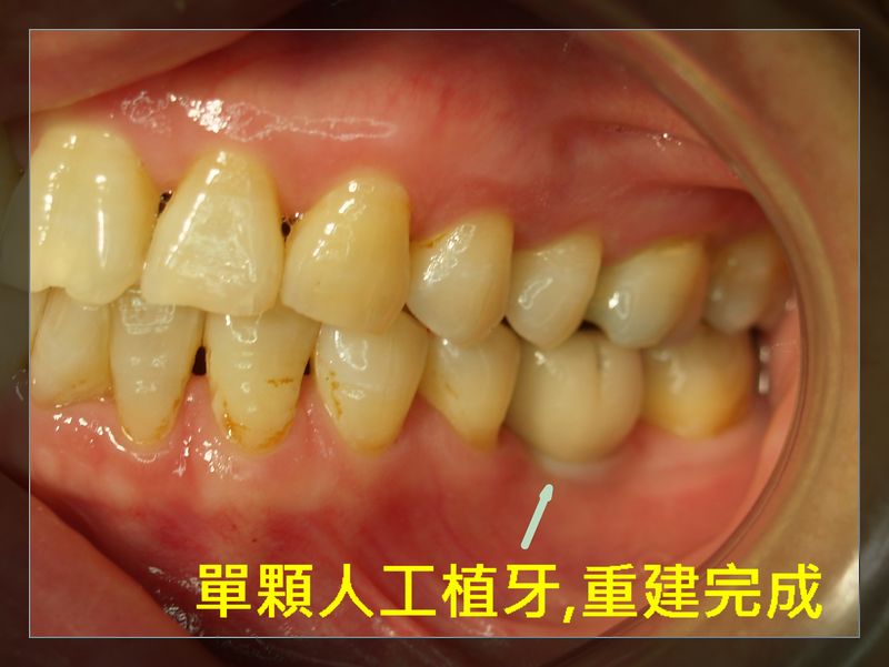 單顆植牙(案例3)